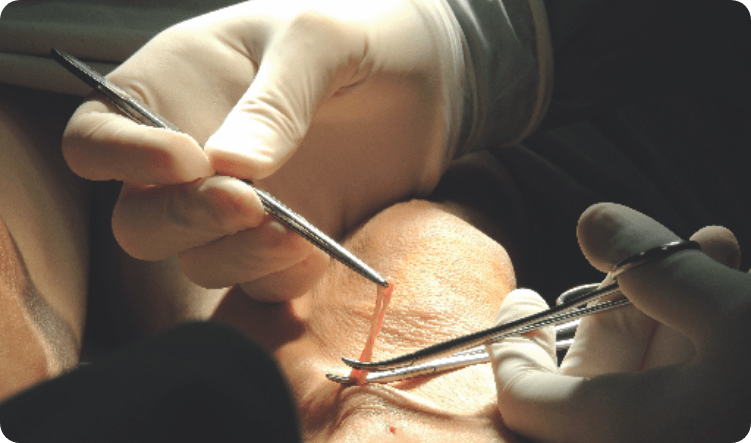 Microvaricectomía-min