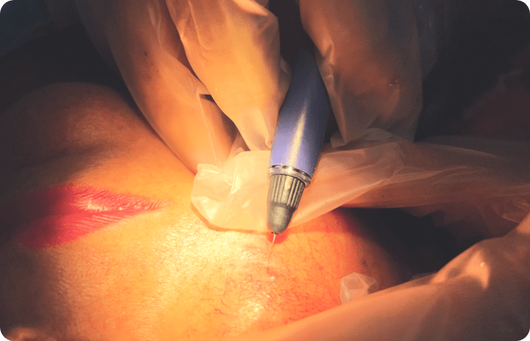 Tecnología VeinGogh-min