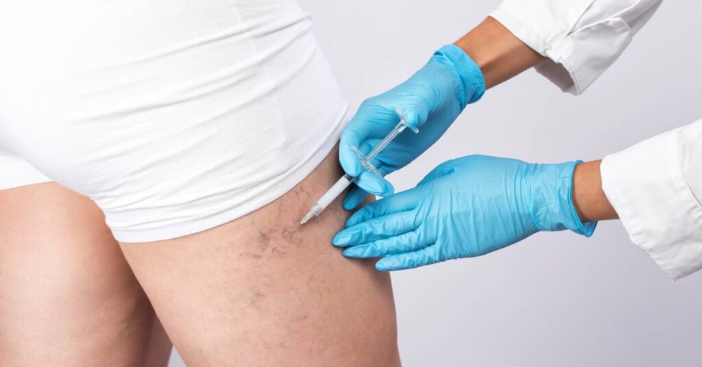Escleroterapia